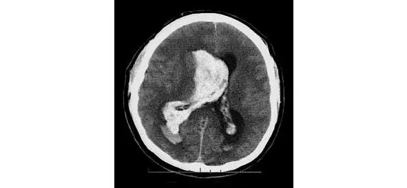 Рисунок 3 КТкартина паренхиматозновентрикулярного кровоизлияния Применение - фото 3