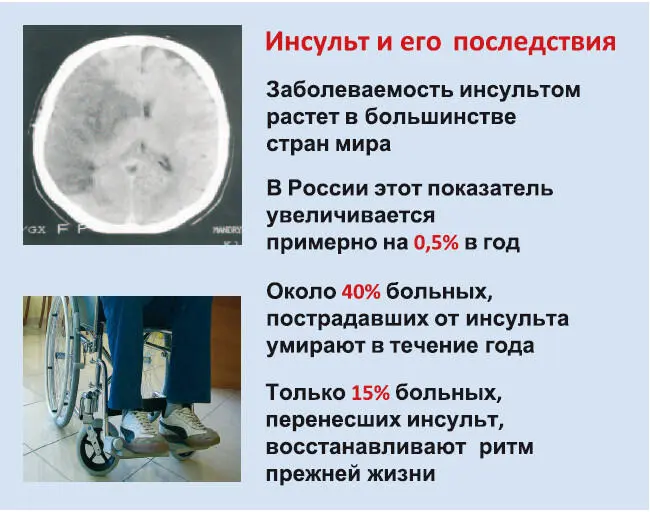 Социальные и экономические аспекты проблемы инсульта в нашей стране изучены - фото 4