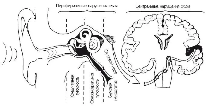Рис 15 Локализация повреждения при разных нарушениях слуха Есть дети у - фото 5