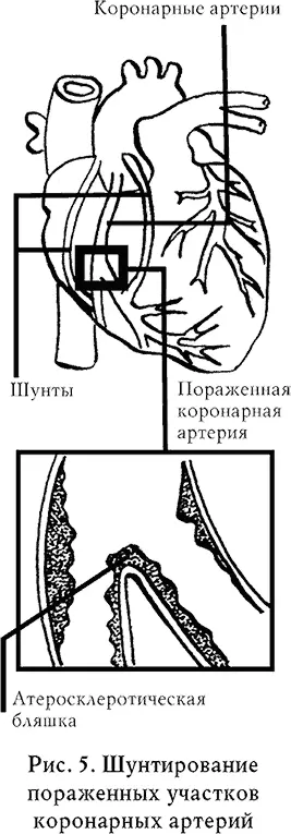 Макрофаги проникая в интиму сосуда внутренний слой скапливаются в ней - фото 11