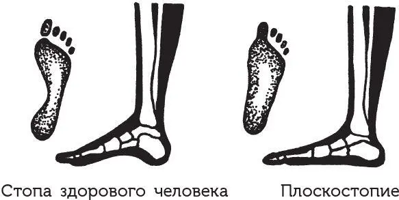 Способствует возникновению плоскостопия и ношение тесной обуви не - фото 9