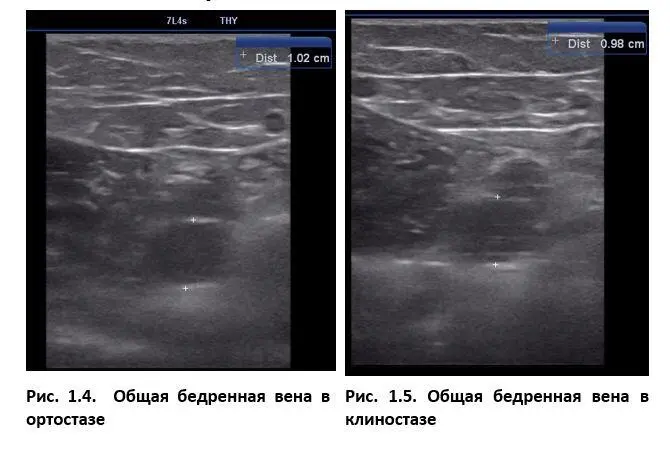 Ультразвуковое исследование вен нижних конечностей мы всегда проводим в - фото 1
