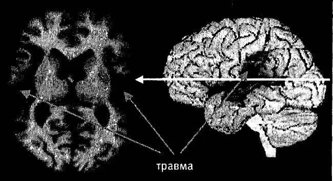 Рис п3Пример МРТскана позволяющего выявить повреждение мозга Этот пациент - фото 3