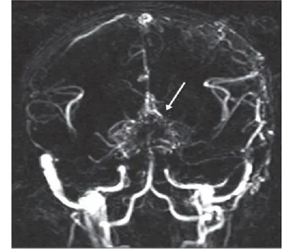 Fig 4MRA of a patient with the moyamoya disease The secondary formation of - фото 4