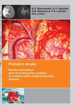 O. Belousova Pediatric stroke. Revascularization and reconstructive surgery in children with cerebrovascular disease обложка книги