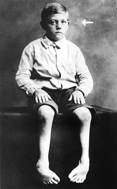 104 In the previous image one of the children suffering from cerebral palsy - фото 14