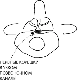 Рис 10 На магнитнорезонансной томографии МРТ сужение канала может быть - фото 11