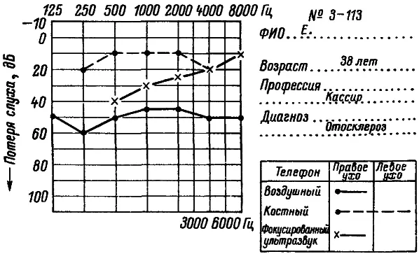 Рис 21 Тональные аудиограммы и ультразвуковая частотнопороговая кривая при - фото 24