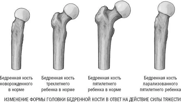 Рисунок 16 Искривление бедренной кости подобно аркбутану это реакция на - фото 19