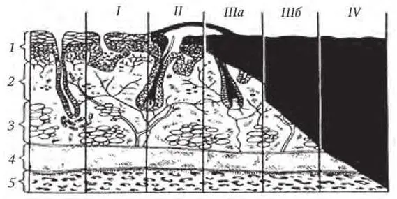 Рис 10 Классификация ожогов по глубине поражения 1 эпидермис 2 дерма - фото 22