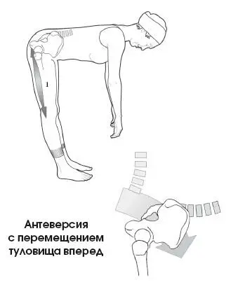 Антеверсия с перемещением туловища вперед и сгибанием позвоночника Диапазон - фото 84