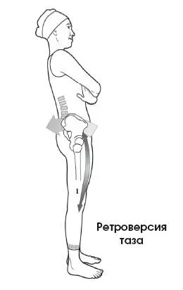 Ретроверсия таза в сочетании с разгибанием позвоночника Ретроверсия таза может - фото 86