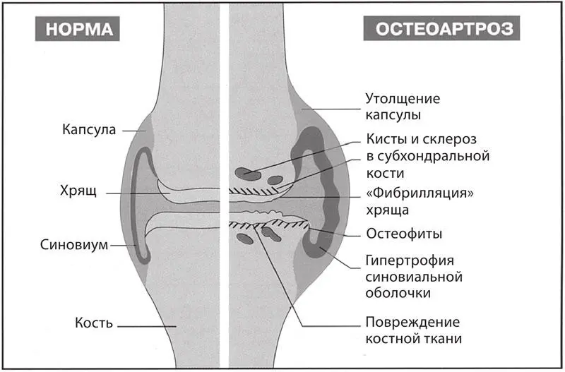 Рис 126Схема сустава в норме и при развитии остеоартроза Наиболее полно - фото 151