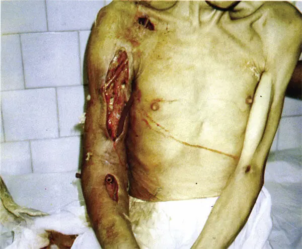 Рис 1 Пассивное дренирование верхней конечности Рис 2 Свободная кожная - фото 37