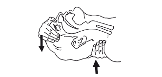 Рисунок 2 Запрокидывание головы для профилактики западения языка Перед тем - фото 2