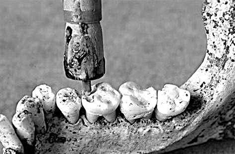 Реконструкция Устройство для сверления зуба с кремневым бором Основой - фото 2