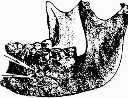 Нижняя челюсть со следами хирургической операции Древний Египет Тем не менее - фото 16