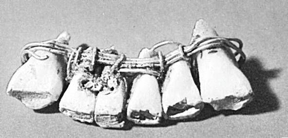Зубной протез обнаруженный в 1862 г в Сидоне Лувр Париж В 1862 г - фото 22