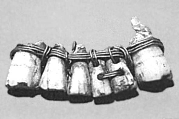 Зубной протез обнаруженный в 1862 г в Сидоне Лувр Париж В 1862 г - фото 23