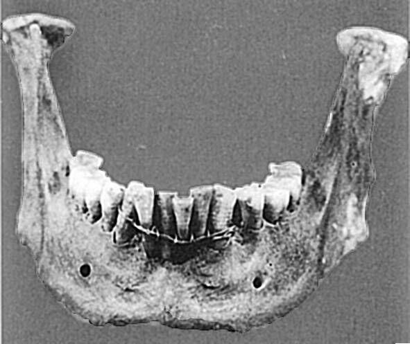 Нижняя челюсть обнаруженная в 1901 г Зубной протез нижней челюсти включал - фото 24