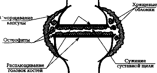 Илл 2б 2я стадия артроза Капсула сустава и расположенная внутри ее - фото 3