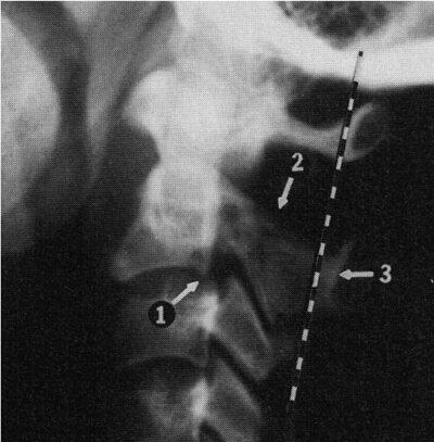 Рис 43Перелом палача цит по L Swischuk Imaging of the Cervical Spine in - фото 6