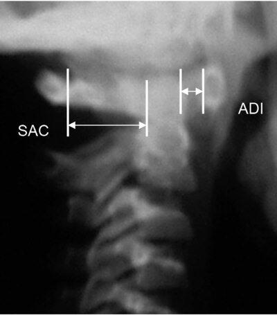 Рис 45Боковая рентгенограмма шейного отдела позвоночника здорового ребенка 8 - фото 8