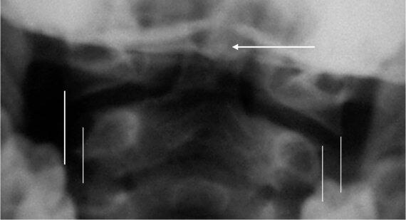 Рис 47Трансоральная рентгенограмма здорового ребенка 4 лет Вертикальными - фото 10
