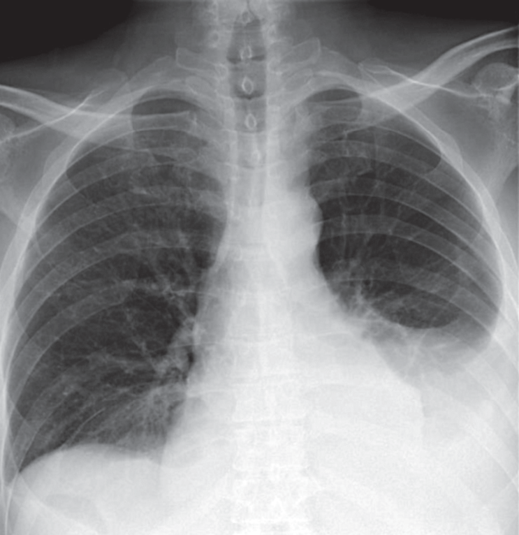 Рис 1 Рентгенограмма пациента Г при поступлении в стационар На основании - фото 1