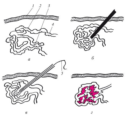 Рис 7 Лазерокоагуляция артериовенозной гемангиомы а сплетение сосудов при - фото 8