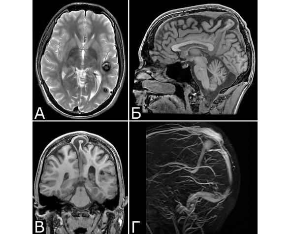 Рис 2Бной П 22 г Сочетанная сосудистая патология мозга Множественные КМ - фото 4