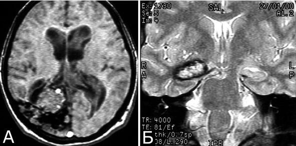 Рис 36 Варианты постгеморрагических изменений мозга вокруг кавернозной - фото 44