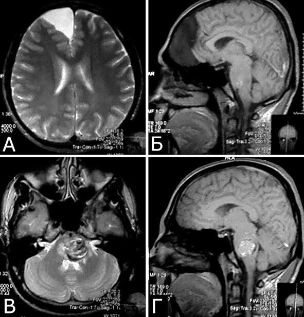 Рис 5Бной Еов 30 лет Сочетанная патология мозга Большая арахноидальная - фото 8