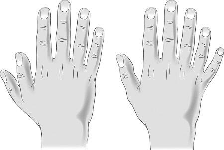 Дополнительный палец при полидактилии обычно менее развит чем остальные - фото 258