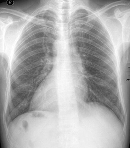 Это рентгеновский снимок пациента с декстрокардией смещением сердца вправо а - фото 259