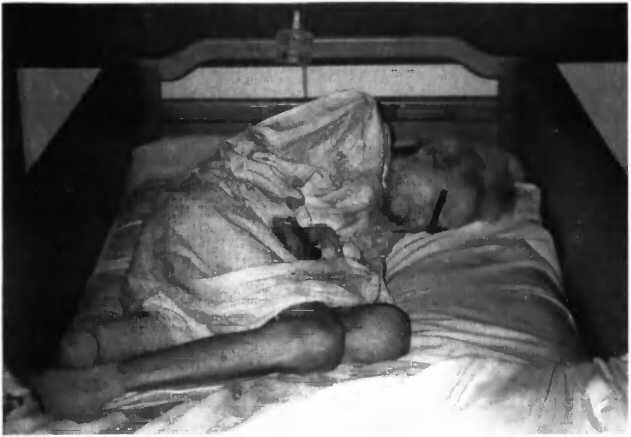 Рис 30 Конечная стадия болезни Альцгеймера больная лежит в постели в позе - фото 42