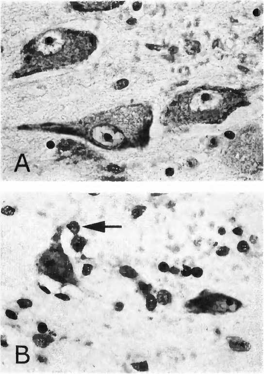 Рис 32 Сморщивание атрофия мозга в базальном ядре Мейнерта при болезни - фото 44