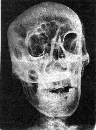 Илл 2 Рентгенологическое исследование мумии по Михайловскому Его извлекали - фото 6