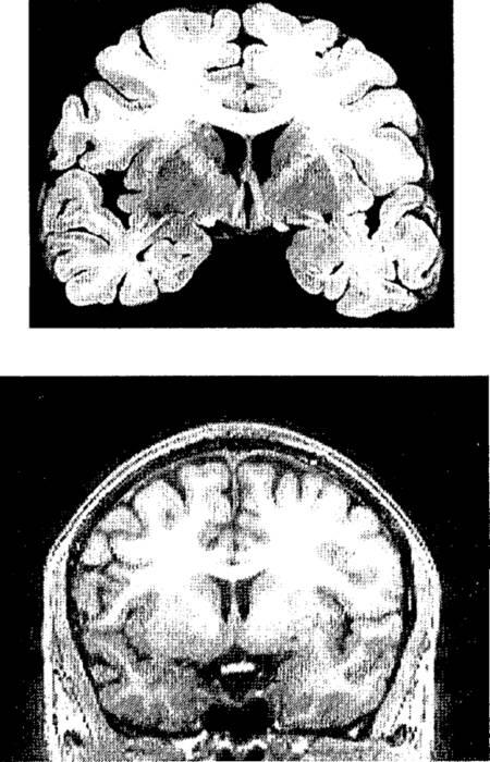 Рис п2Пример полученного с помощью МРТ структурного изображения мозга и срез - фото 2