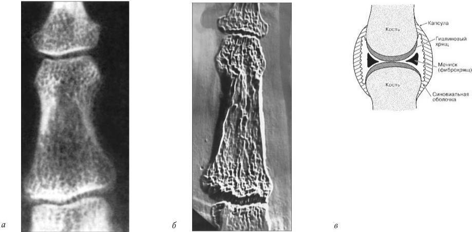 Рис 2 Рентгенограмма дистального и проксимального межфаланговых суставов V - фото 2
