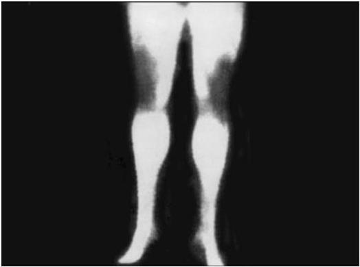 Рис 3 в Термограмма нормальных коленных суставов Их контуры ровные - фото 5